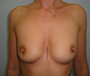 Photo before procedure: Breast augmentation  (photo 19)