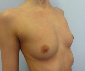 Zvětšení prsou anatomickými implantáty Mentor 