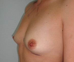 Augmentace - zvětšení prsou 